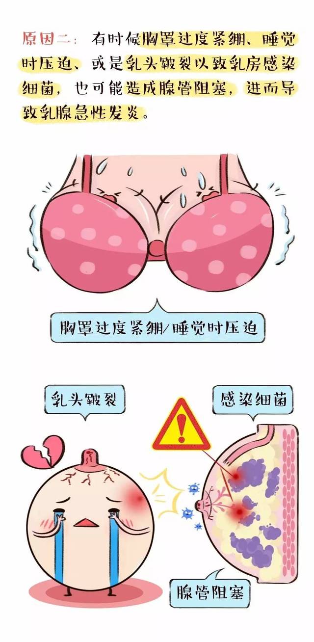 关于『哺乳期乳腺炎』,你一定得知道的事!