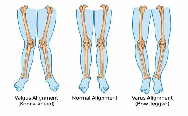 科普丨为什么很多小宝宝都是o型腿?需要看医生吗?