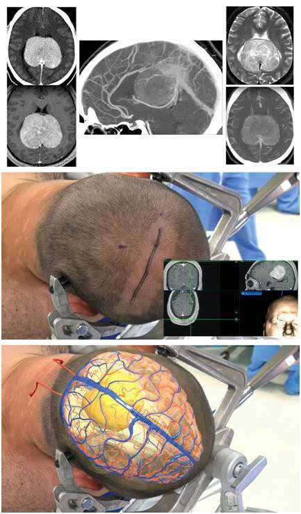 镰旁脑膜瘤手术策略与技巧 | the neurosurgical atlas全文翻译