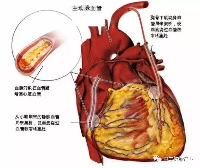 解密:心肌梗塞是怎么一回事?