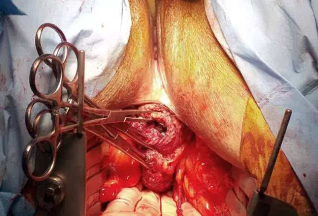 无淋巴结转移的结直肠癌患者淋巴结切除数目对预后的影响