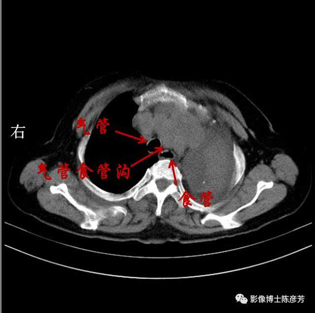 气管食管沟内充满软组织影.喉返神经受压.