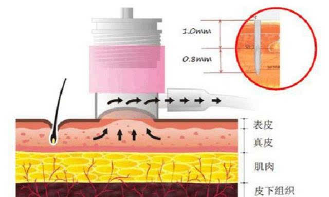 水光针危害太大,打水光针有了副作用好后悔呀