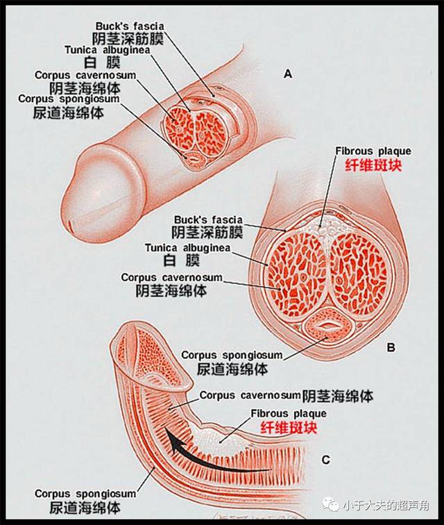 超声表现:pd可表现为阴茎海绵体背侧紧邻处中-低回声结节,外形不规则