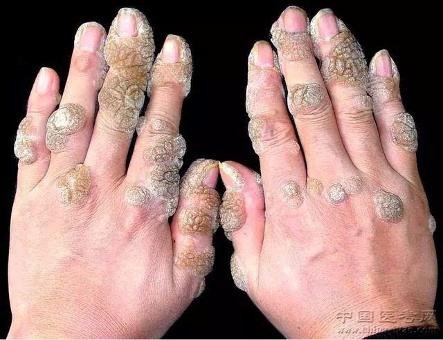 手指部疣状表皮发育不良(放大图像)