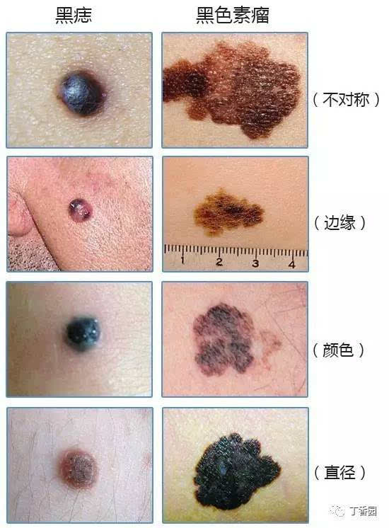 黑色素的痣细胞所组成的良性皮肤肿瘤,但有少数可能恶变成为黑色素瘤