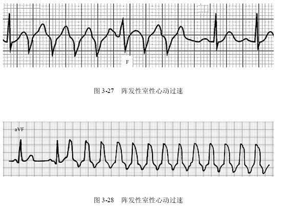 ⑥ 室速,表现为一系列宽大畸 图15 ⑦ 心室扑动,比较少见,一般常