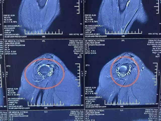 小伙肩膀长出190颗软骨瘤,这病和运动