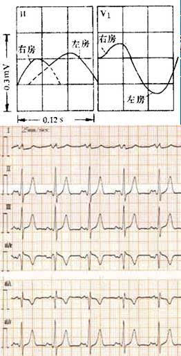 右房肥大常见于肺心病,肺动脉高压等,该p波常称为肺型p波.