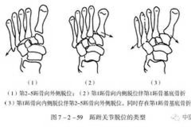 平乐正骨手法:跖跗关节脱位的治疗