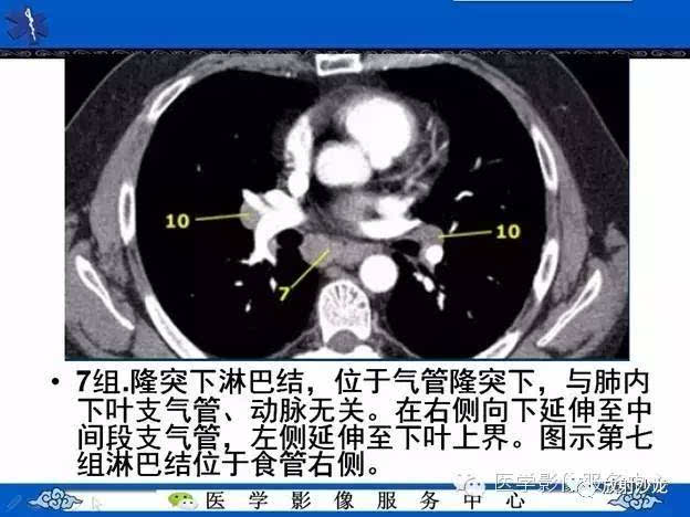 隆突下区:肿大淋巴结位于支气管分义下或分义部的前,后方.