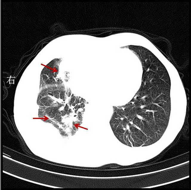 右肺中,下叶斑块状,条索状病灶,内有钙化灶.