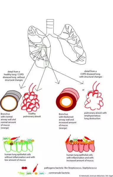 慢阻肺:病变在肺结构,改变在微环境