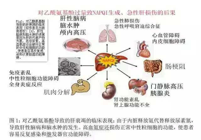 药物不良反应:对乙酰氨基酚导致肝衰竭