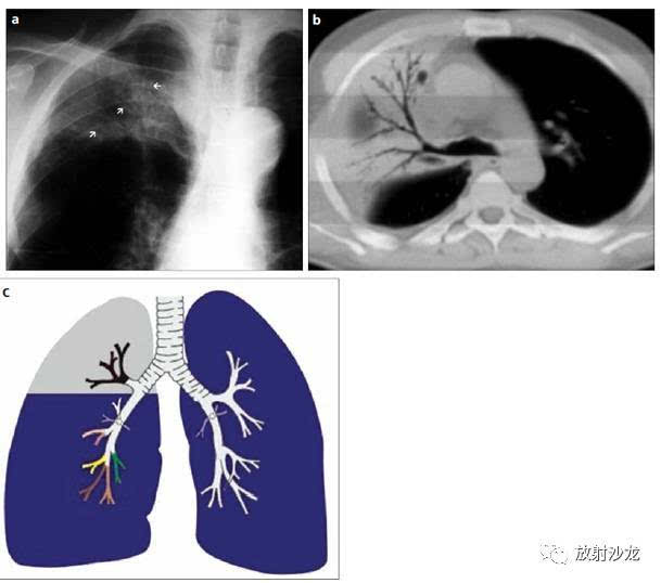 看到空气支气管征,要想到这些