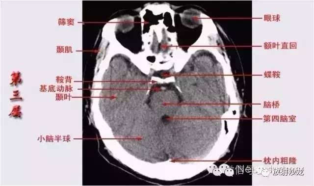 【推荐】头颅ct的断层解剖——全是图