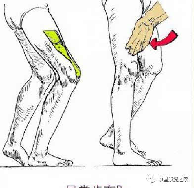 时,胫骨在支撑相中期和后期向前行进过分,导致踝关节不稳或膝塌陷步态