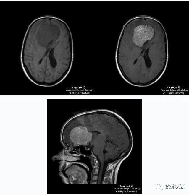 嗅沟脑膜瘤(olfactory meningioma)mri-ct病例影像诊断分析