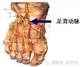 手把手教会护士,正确的动脉采血(部位,方法)