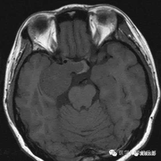 t1示右侧海绵窦旁均匀等低信号,侵及鞍区及鞍旁.