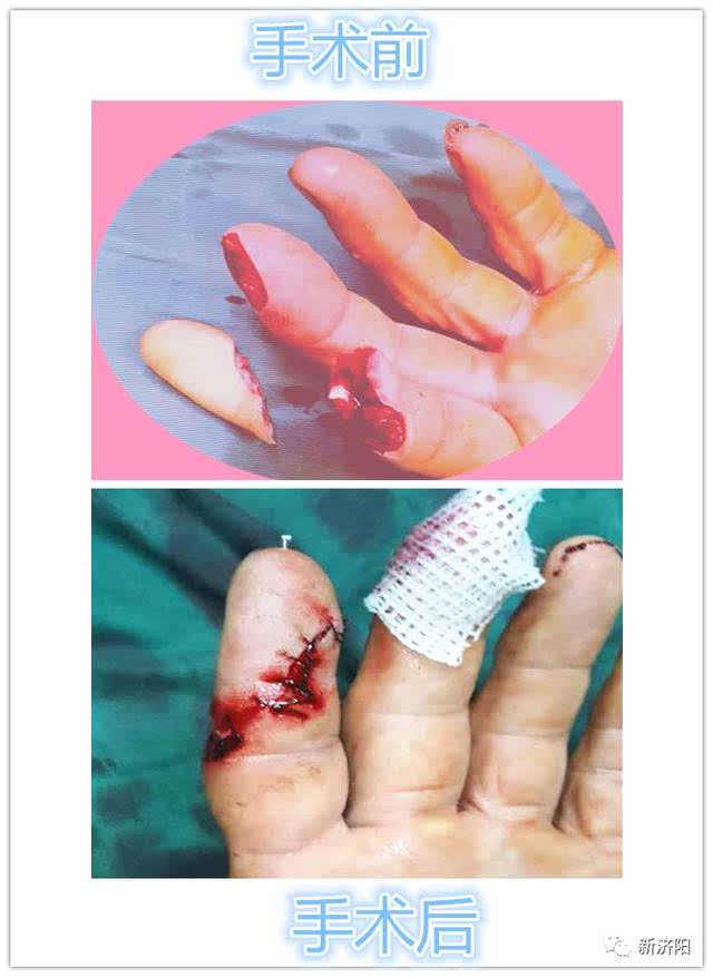 手指末节断指再植术是在恢复患指正常解剖的基础上重建血液循环,目的