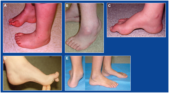 高弓内翻足和扁平外翻足畸形 儿童足踝外科的诊断方法