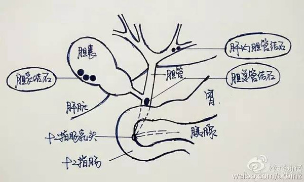 胆管结石和胆囊结石有什么区别?