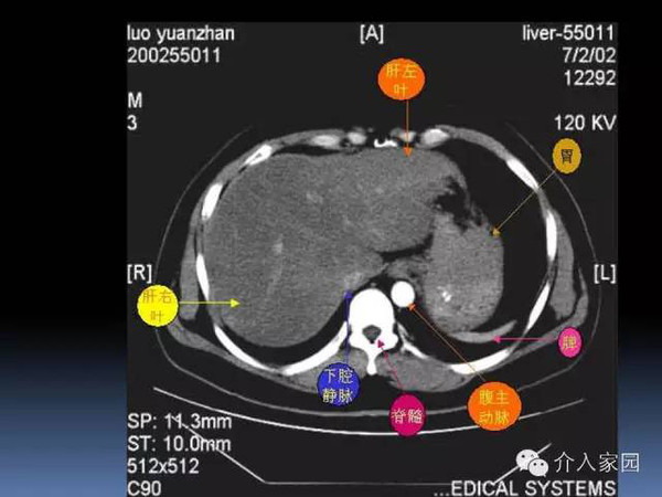 肝脏分段及血管详细辨识教程(断层解剖 影像学)