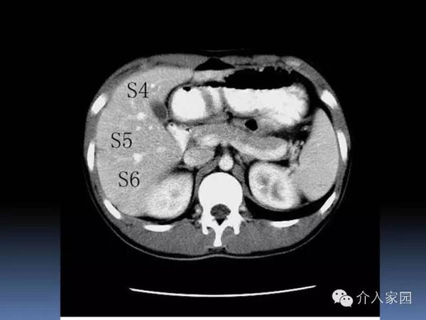 肝脏分段及血管详细辨识教程(断层解剖 影像学)