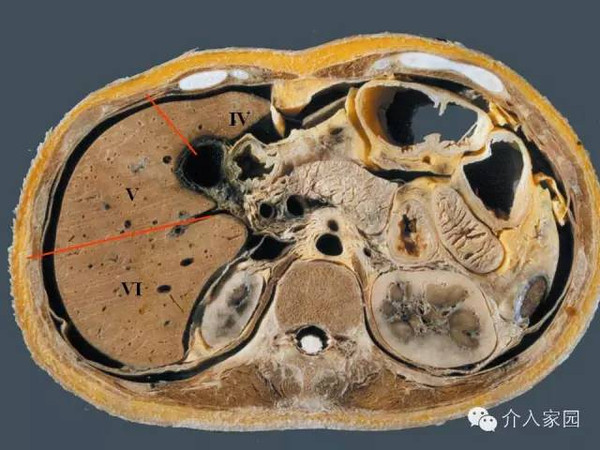 肝脏分段及血管详细辨识教程断层解剖影像学
