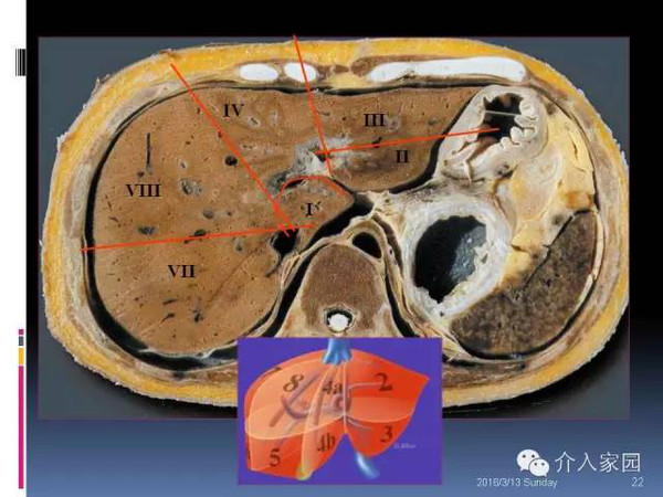 肝脏分段及血管详细辨识教程(断层解剖 影像学)