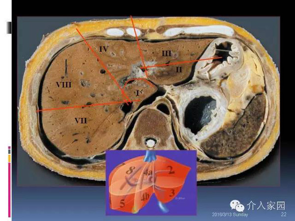 肝脏分段及血管详细辨识教程断层解剖影像学