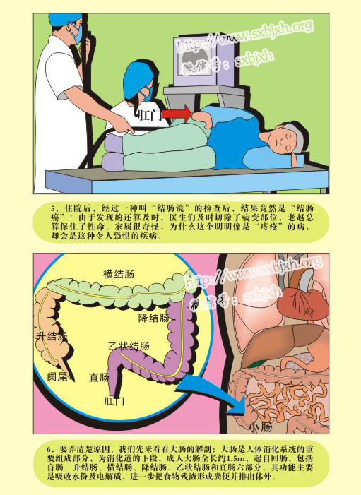 图解疾病——结肠癌