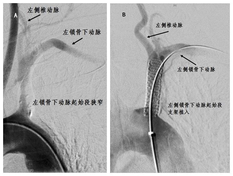 头晕,上肢无力--小心锁骨下动脉窃血综合症