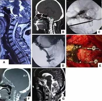 2a).颈椎重建ct扫描显示颅底凹陷症和局部寰枕融合症.