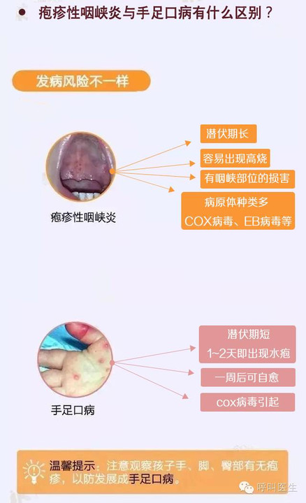 儿童疱疹性咽峡炎或高发,比手足口病还可怕