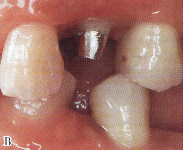 牙体严重缺损前牙根管治疗后的修复——黄翠教授
