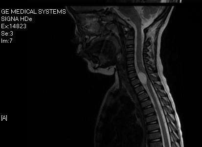 椎管内肿瘤有什么症状 颈椎椎管内肿瘤手术 椎