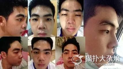 人艰不拆 泰国质朴小哥花百万整容变网红帅哥