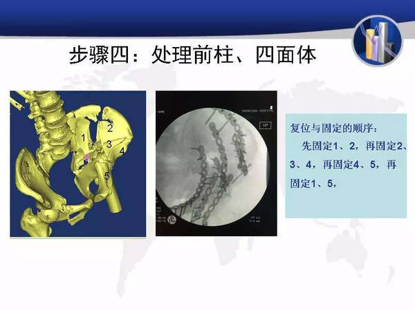 经典病例复杂骨盆合并髋臼骨折