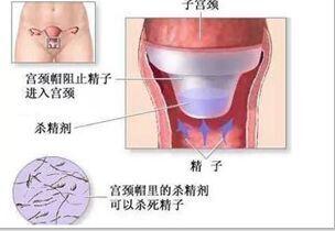 碘伏的原理_碘伏和碘酒的区别   碘酒和碘伏都可以用来消毒,但是碘酒对皮肤的刺激性比碘伏要(2)