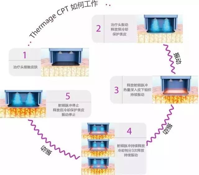 超短波脉冲治疗是什么原理_超短波治疗图片