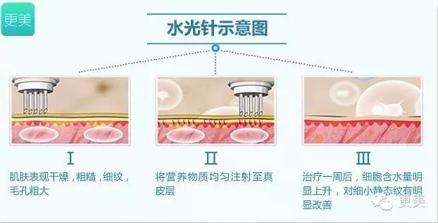 玻尿酸和肉毒素可以同时打?水光针后还能做激