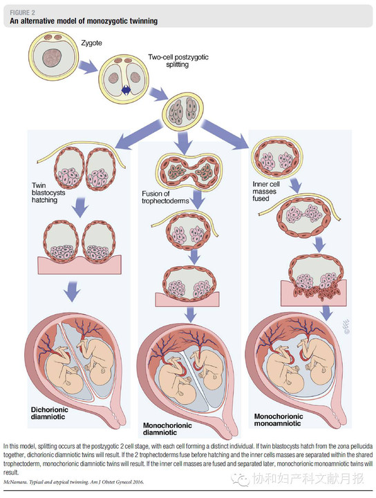 史精华:典型和非典型双胎发生机制的研究及证