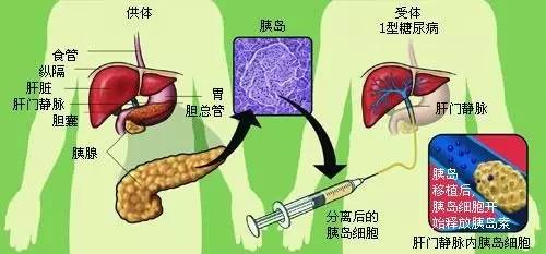 比如饮食,运动等,能够最大程度的缓解糖尿病特别是胰岛素抵抗的状况