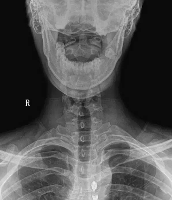 颈椎x光片的读片要点及常见异常改变汇总