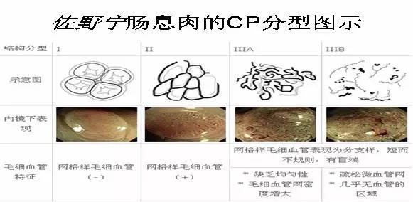 规范的肠镜检查是提高早期肠癌检出率的根本收藏