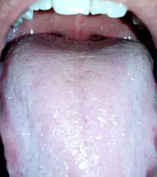 舌诊看病:这种舌苔或预示胃癌