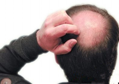 脂溢性脱发的护理方法
