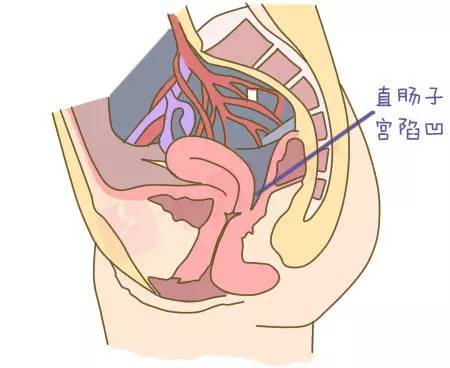 盆腔中的直肠子宫陷凹,是女性站立时盆腔的最低点,当有盆腔液体时就会